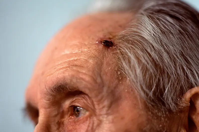 What are the ICD-10 Codes for Merkel Cell Carcinoma?