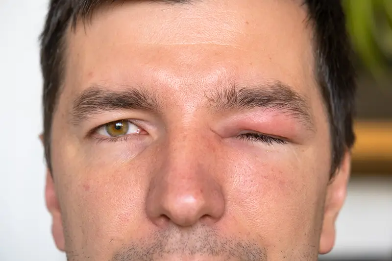 ICD-10 Codes to Report Anaphylaxis – A Severe and Life-threatening Allergic Reaction