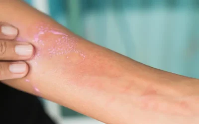 ICD-10 Codes To Report Eczema