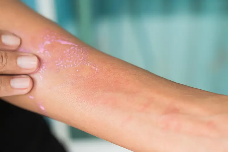 ICD-10 Codes To Report Eczema