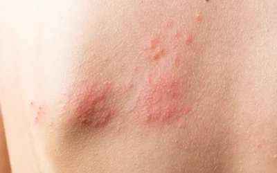 Medical Codes to Report Herpes Zoster or Shingles