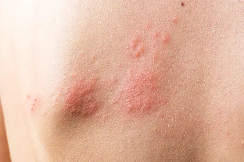 Medical Codes to Report Herpes Zoster or Shingles