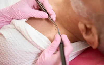 What are Criteria and CPT Codes for Reporting Skin Lesion Removal?