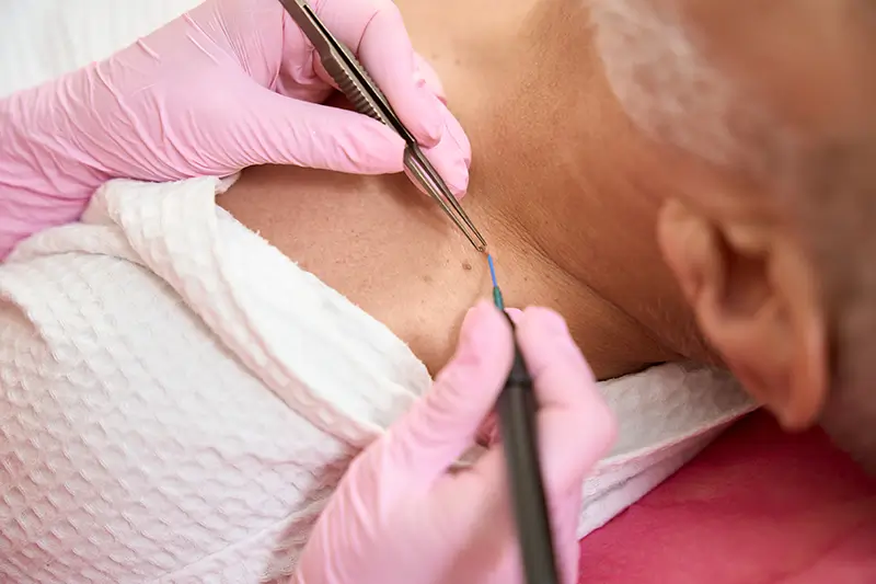 What are Criteria and CPT Codes for Reporting Skin Lesion Removal?