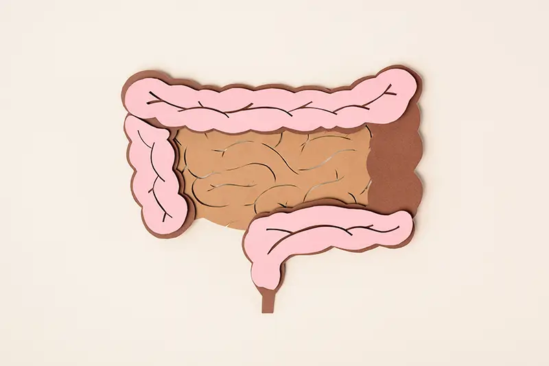 ICD-10 Codes To Report Diverticulosis