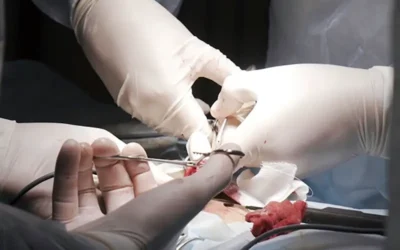 What Is TAVR and How Do You Code the Procedure?