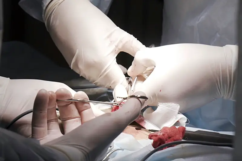 TAVR Procedure TAVR Procedure