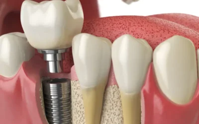 CDT Codes to Report Dental Implant Services