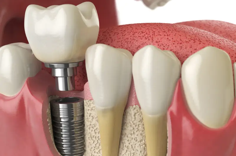 CDT Codes to Report Dental Implant Services