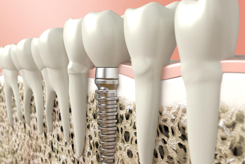 CDT Codes to Report Dental Implant Services