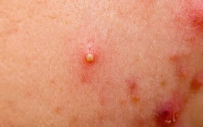 Coding Skin Disorders Using ICD-10 Medical Codes