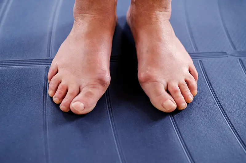 Codes to Report Foot Deformities in Podiatry Billing