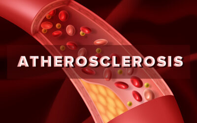 Documenting Atherosclerosis Cardiovascular Disease with ICD-10 Code