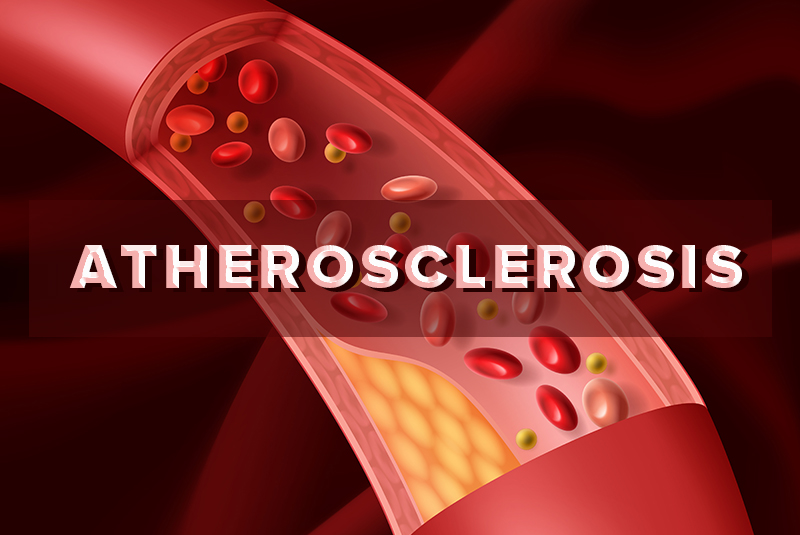 Documenting Atherosclerosis Cardiovascular Disease with ICD-10 Code