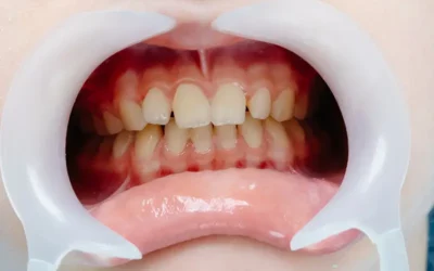 Dental and Medical Billing Guidelines for Frenectomies