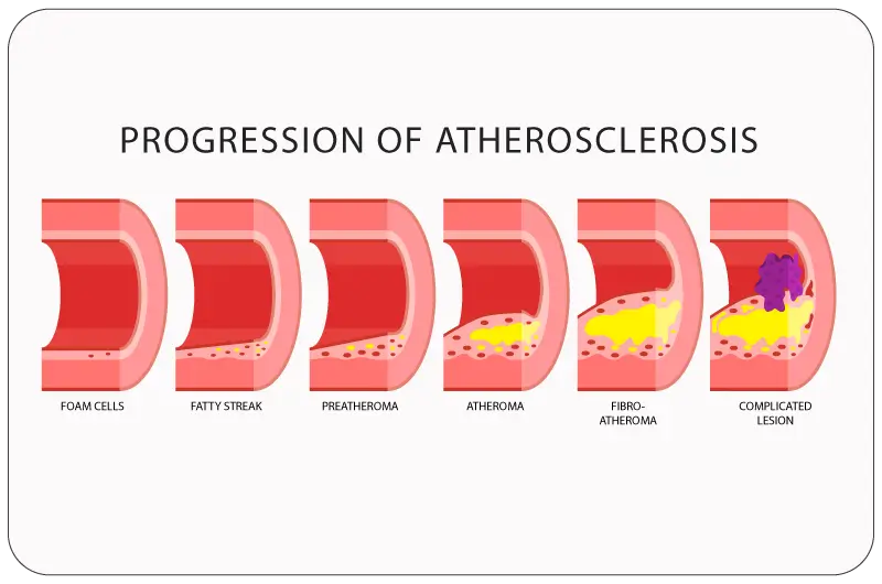 Documenting Atherosclerosis Cardiovascular Disease with ICD-10 Code