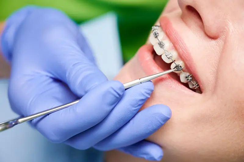 Medicaid Coverage for Orthodontics