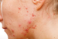 Medical Coding for Acne – A Common Skin Condition