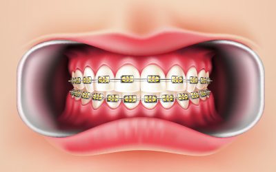 Medicaid Coverage for Orthodontics