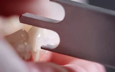 What are the CDT codes to Report Bone Grafts?