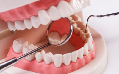 What are the CDT codes to Report Bone Grafts?