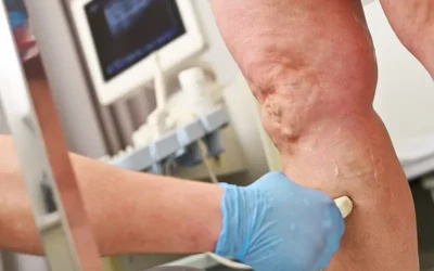 Coding Different Types of Vascular Disease – A Look at the Related ICD-10 Codes