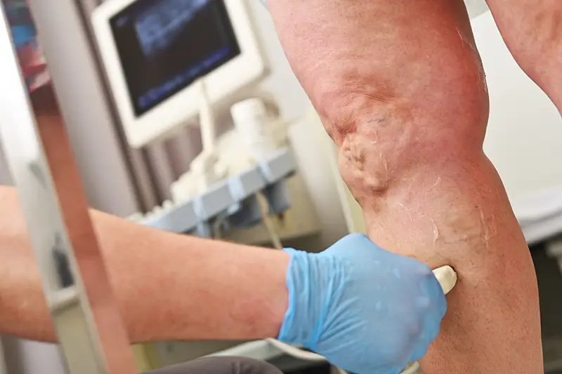 Coding Different Types of Vascular Disease – A Look at the Related ICD-10 Codes