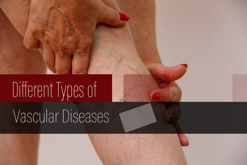 Different Types of Vascular Diseases
