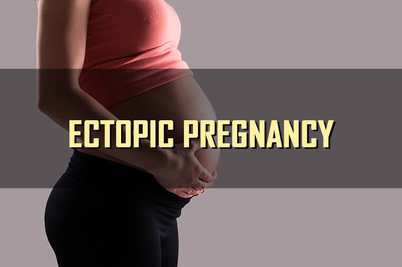 Ectopic Pregnancy