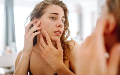 Medical Coding for Acne – A Common Skin Condition
