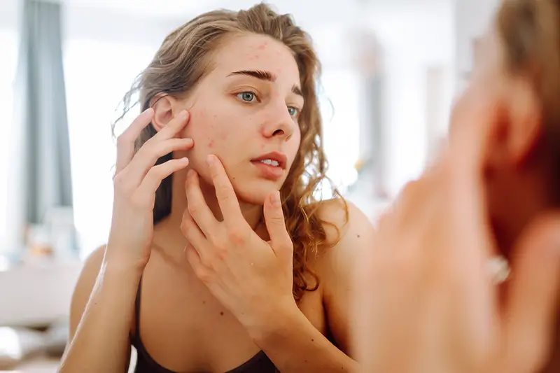 Medical Coding for Acne - A Common Skin Condition