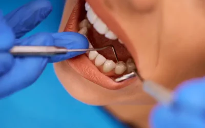 How Do You Report Fractured Tooth Using ICD-10?