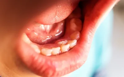 What Are the Codes to Report Supernumerary Teeth?
