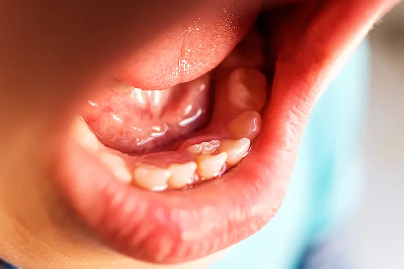 What Are the Codes to Report Supernumerary Teeth?