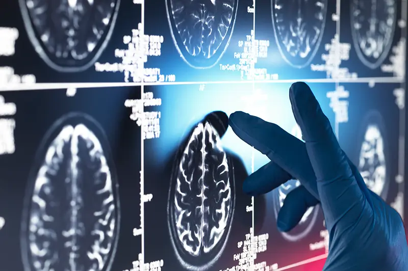 Medical Coding for Top Six Neurological Conditions