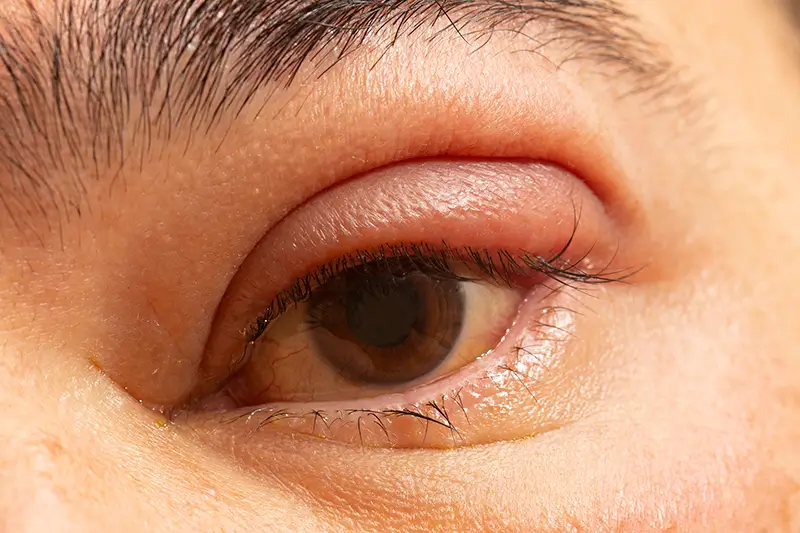ICD-10 Coding for Blepharitis – A Common Eye Disorder