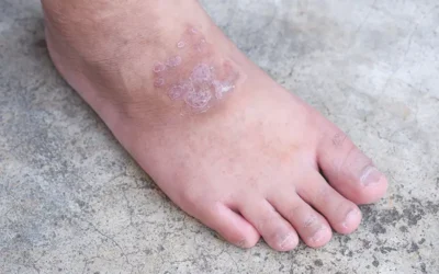 Medical Codes for Reporting Diabetic Blisters on Your Claims