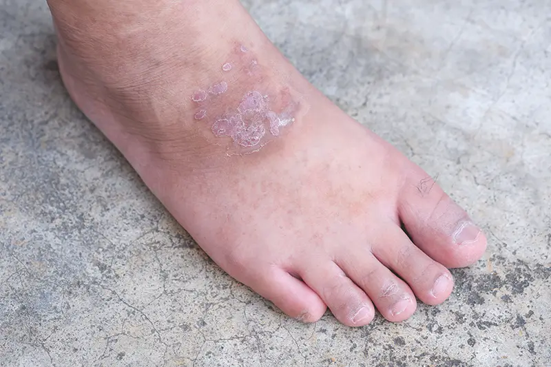 Medical Codes for Reporting Diabetic Blisters on Your Claims