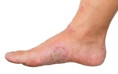 Medical Codes for Reporting Diabetic Blisters on Your Claims