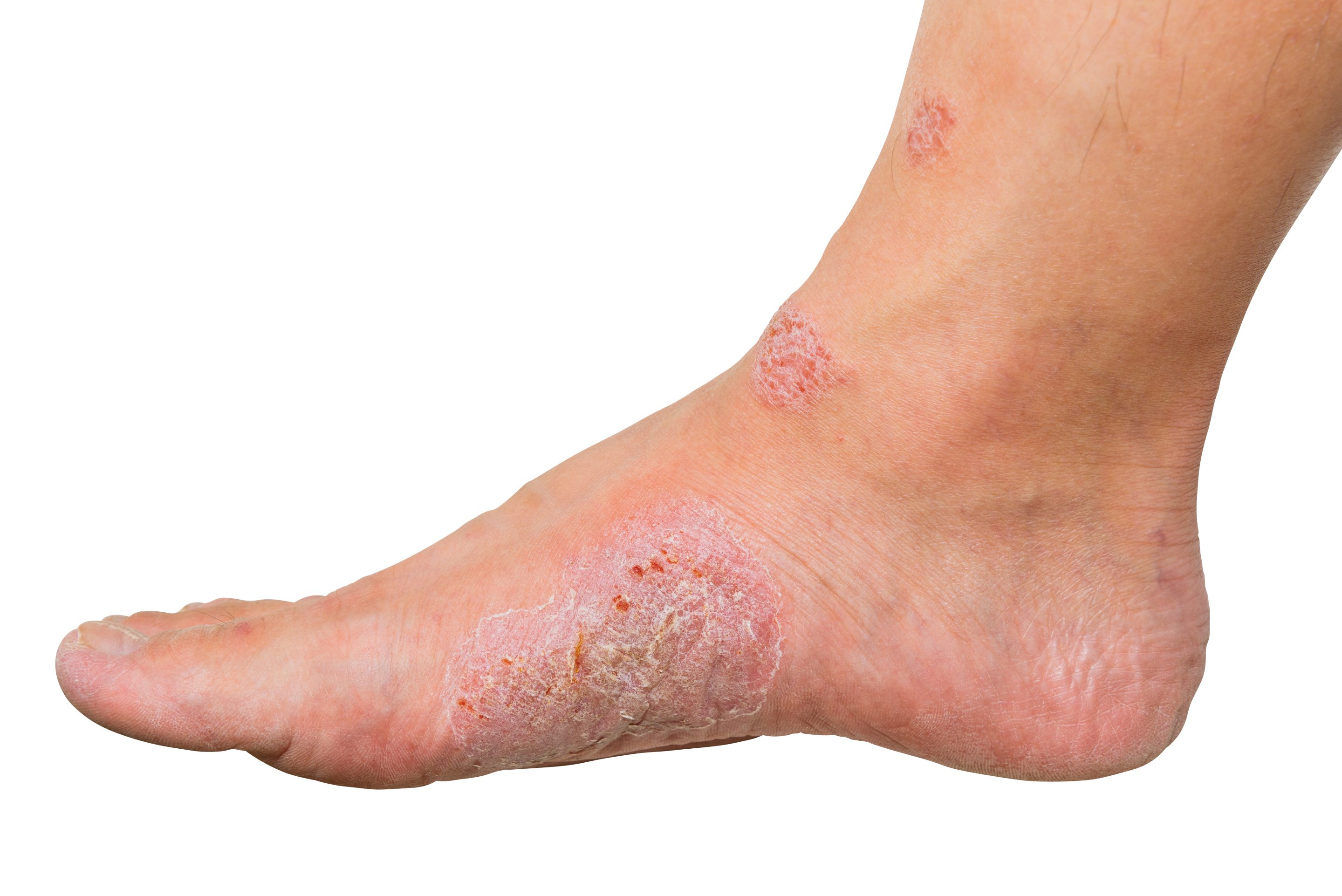 Reporting Diabetic Blisters on Your Claims