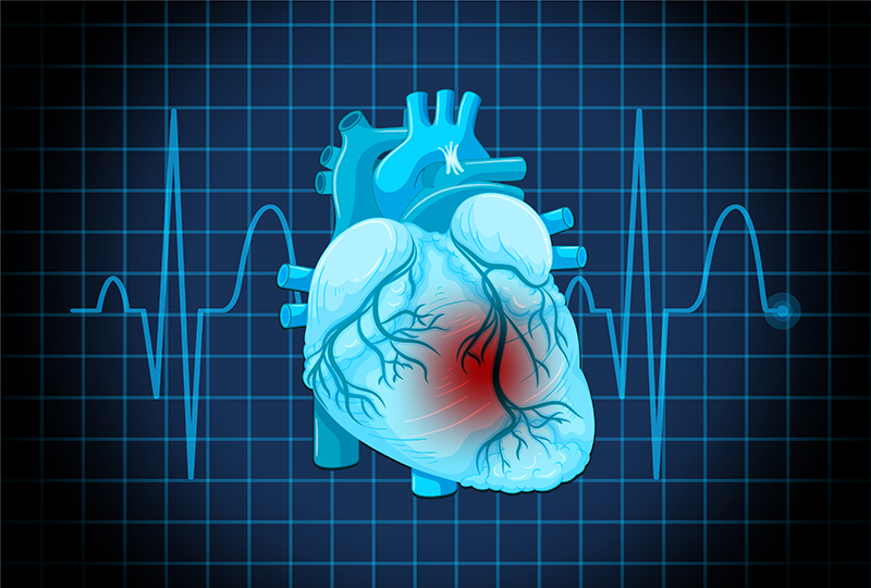 Cardiomyopathy A Common Cardiac Condition