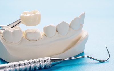 What Are the CDT Codes for Dental Bridge?