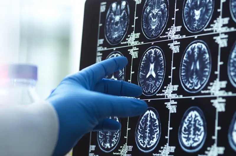 Medical Coding for Encephalitis – Reporting Signs and Symptoms