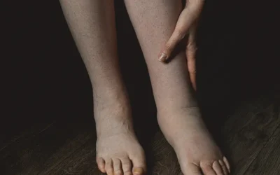 Medical Coding for Lymphedema – A Common Vascular Disease