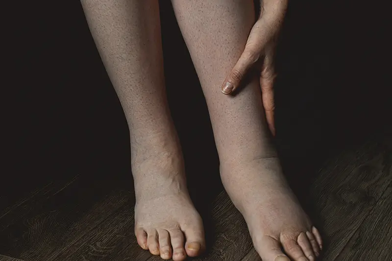 Medical Coding for Lymphedema – A Common Vascular Disease