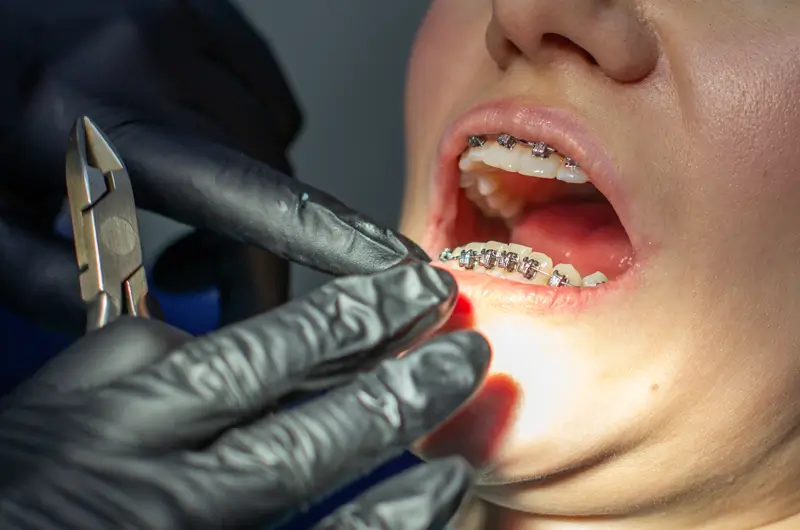 What are the Different Types of Malocclusions and their ICD-10 Codes?