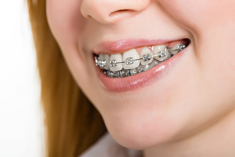 Malocclusion