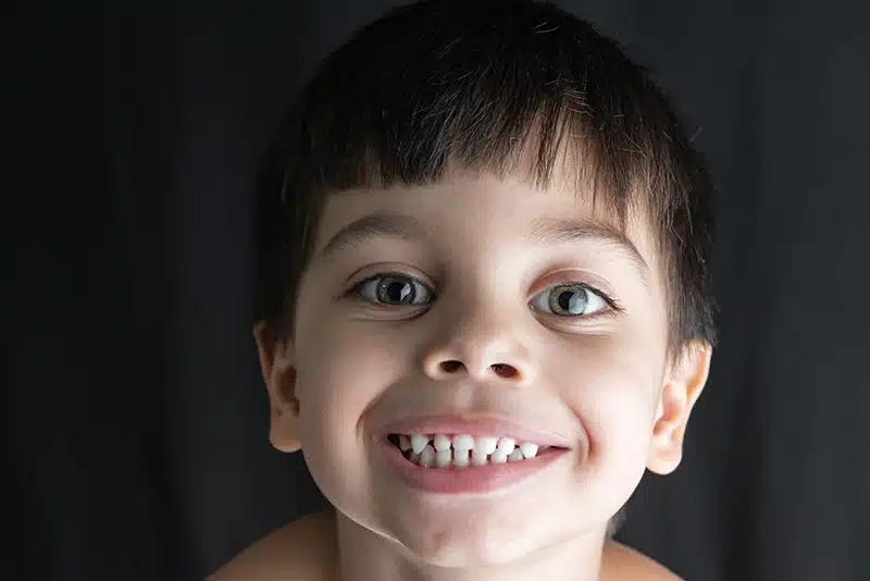 Tooth Developmental Disorders