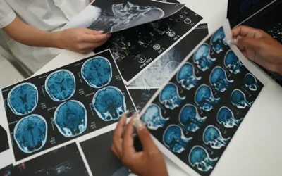 How do you Code and Bill for Subdural Hematoma?