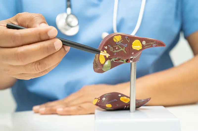 How to Bill and Code for Liver Cirrhosis